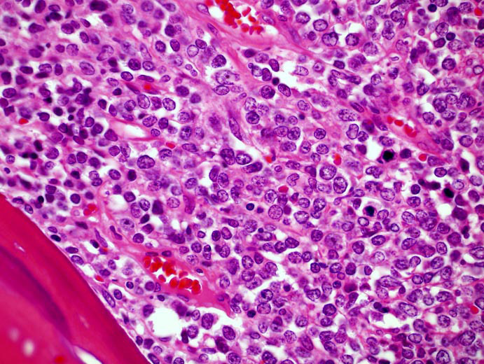 759-myeloid-sarcoma-4-sarcoma-images.jpg