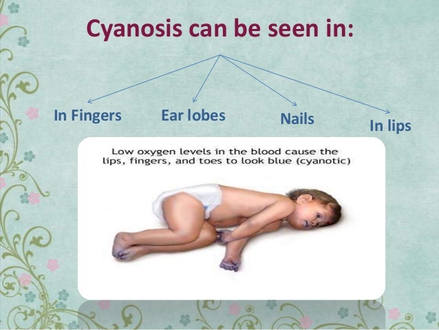 cyanosis-6-638.jpg