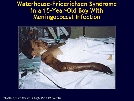 waterhouse-friderichsen-syndrome.gif