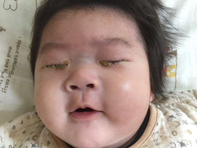 生後４ヶ月の赤ちゃんの目やにで目が開かない状態に 先天性鼻涙管閉塞か クローン病 陸トトの今日もopp